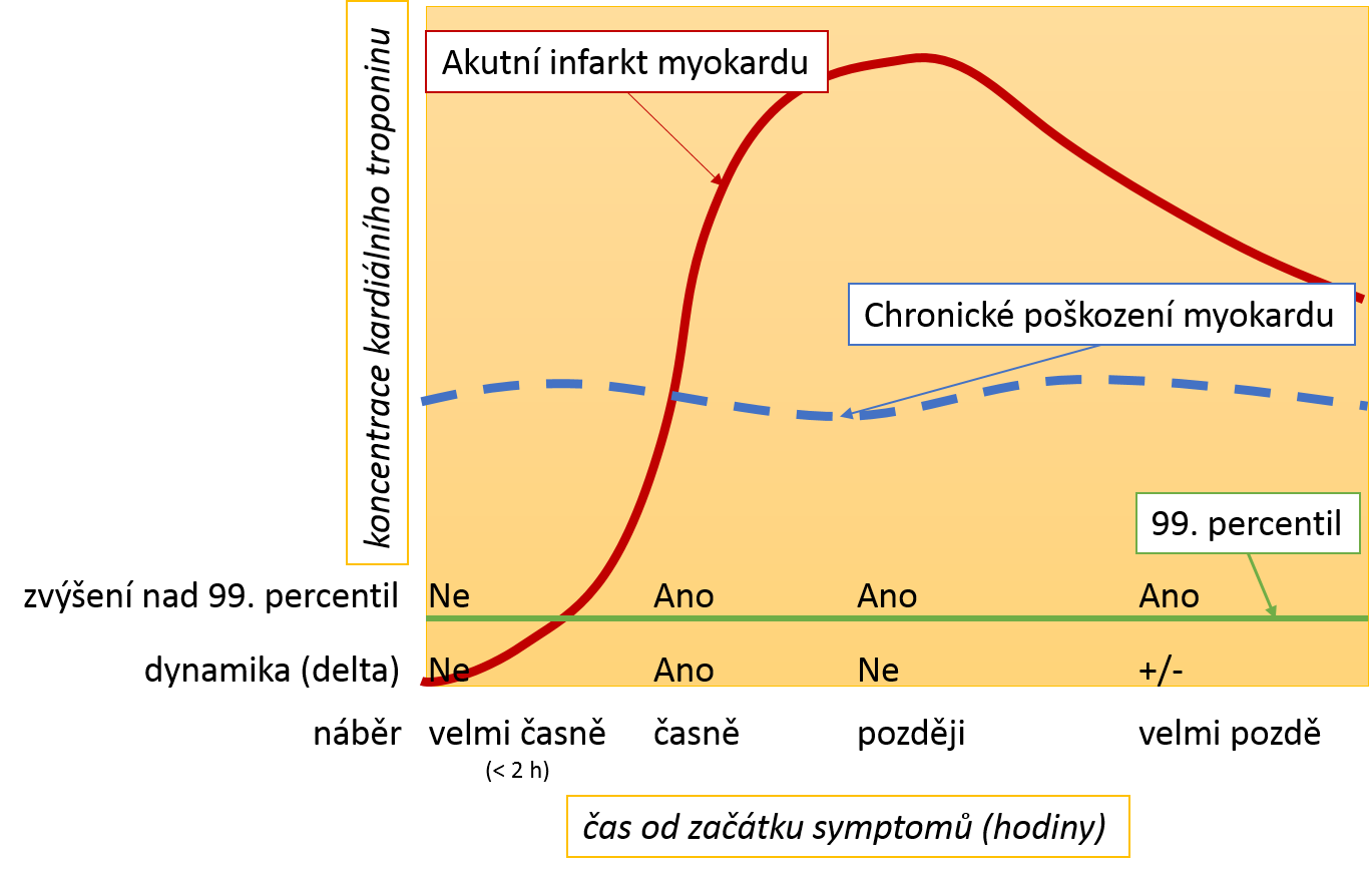 Časový průběh kardiálních troponinů při akutním a chronickém poškození myokardu.